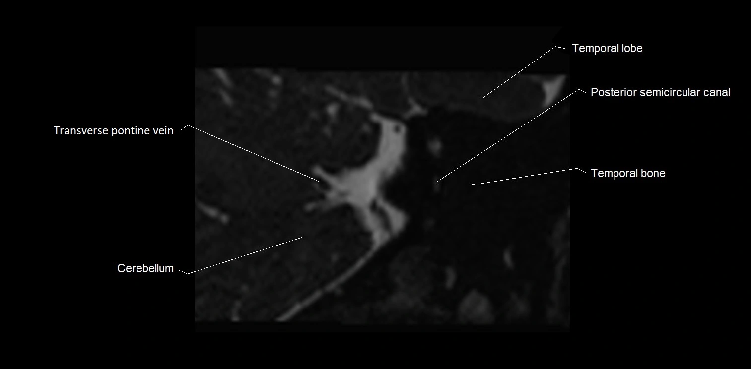 MRI Internal auditory meatus (IAM) coronal cross sectional labelled anatomy image 35.webp